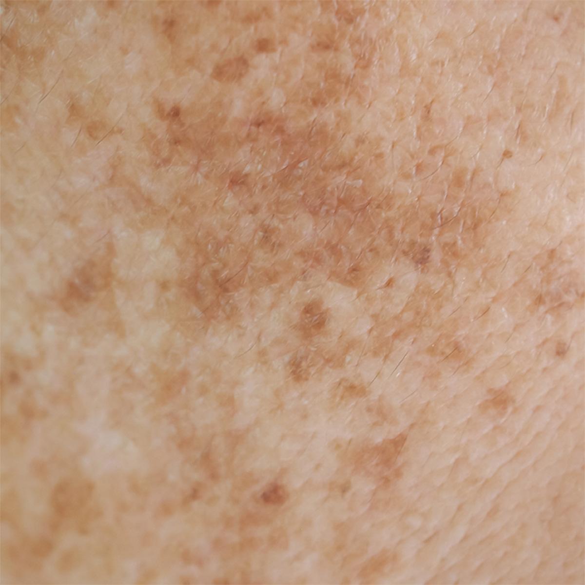 Understanding Hyperpigmentation
